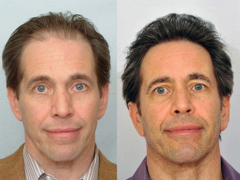 Hair Transplant 2701 grafts FUE front view 2