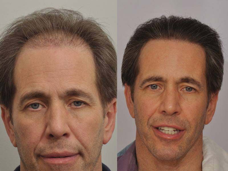 Hair Transplant 2701 grafts FUE front view 3