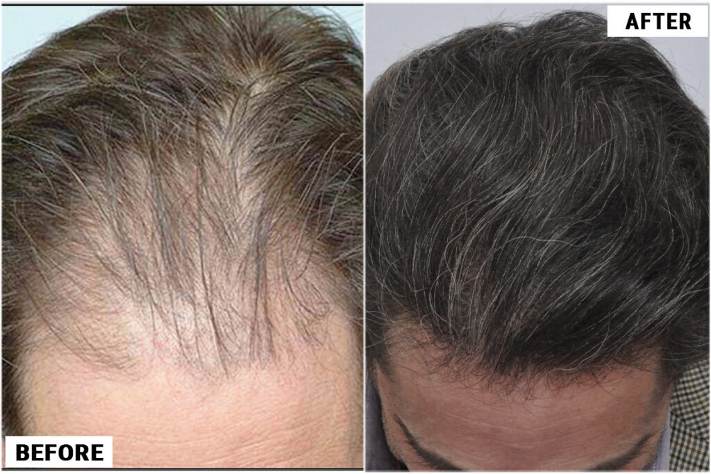 Hair Transplant 2701 grafts FUE top view
