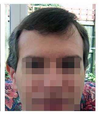 Hair Transplant 4289 grafts FUE