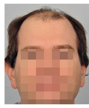 Hair Transplant 4289 grafts FUE