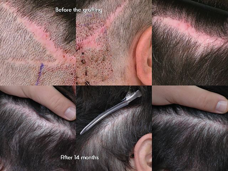 Before and after scar 8-14 months #2