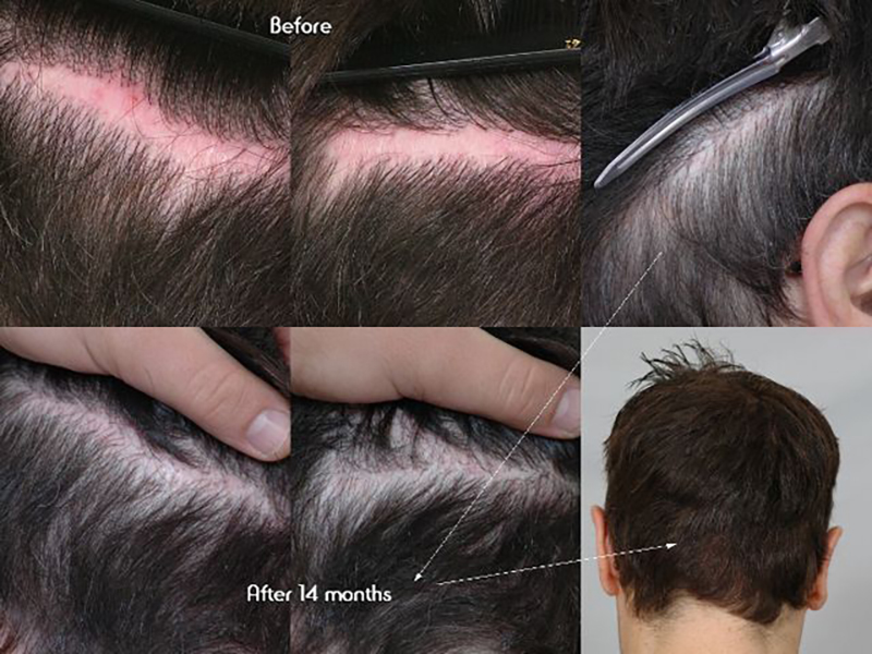 Before and after scar 14 months
