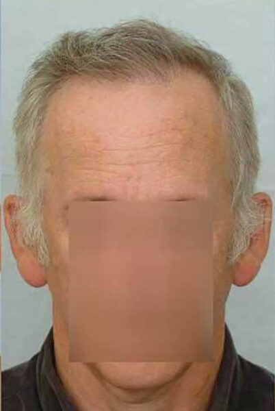 Hair Transplant 6102 grafts FUE