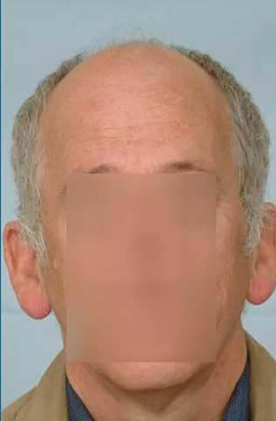 Hair Transplant 6102 grafts FUE