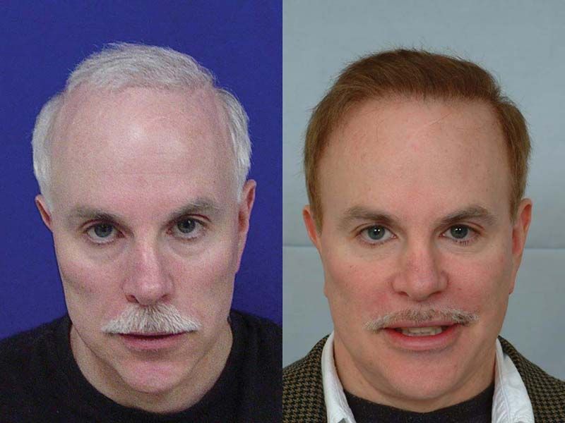 Hair Transplant 6800 grafts FUE