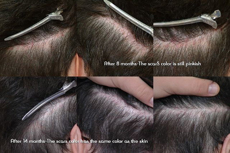 Scar Repair 300 grafts FUE 8-14 months post-up