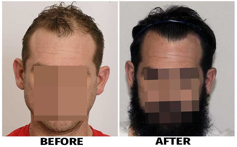 Growth Factor Therapy