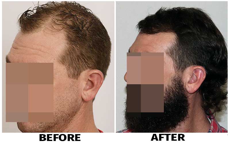 Before After right view