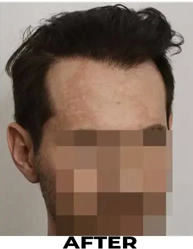 Hair Transplant 2234 grafts FUE