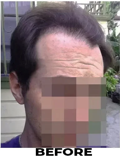 Hair Transplant 2234 grafts FUE