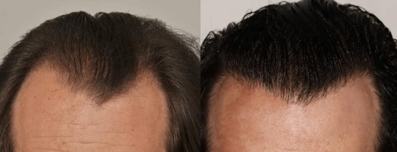 Hair Transplant 2234 grafts FUE