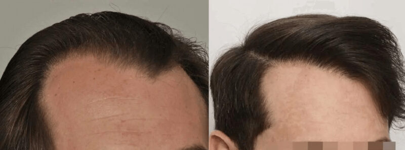 Hair Transplant 2234 grafts FUE right side
