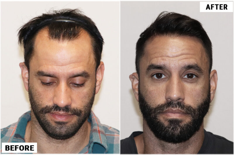 Hair Transplant 2930 grafts FUE front