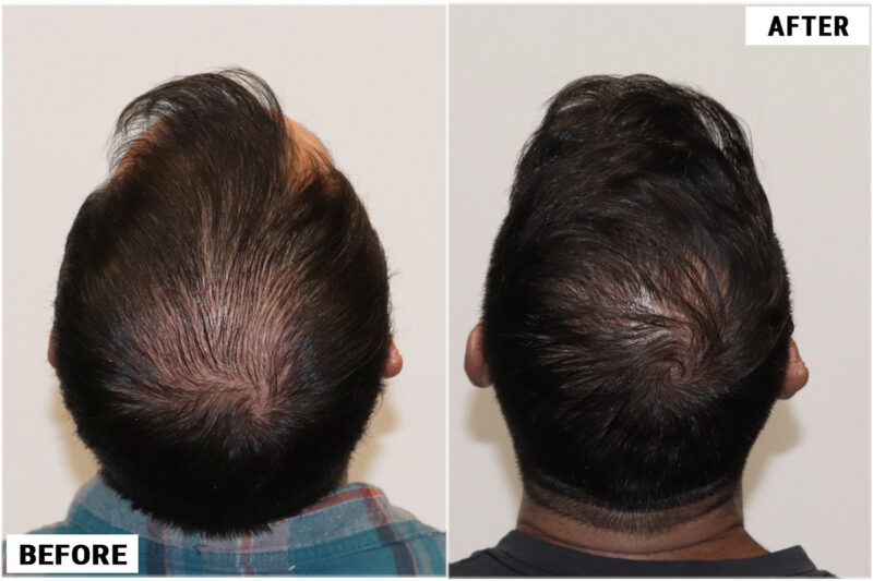 Hair Transplant 2930 crown