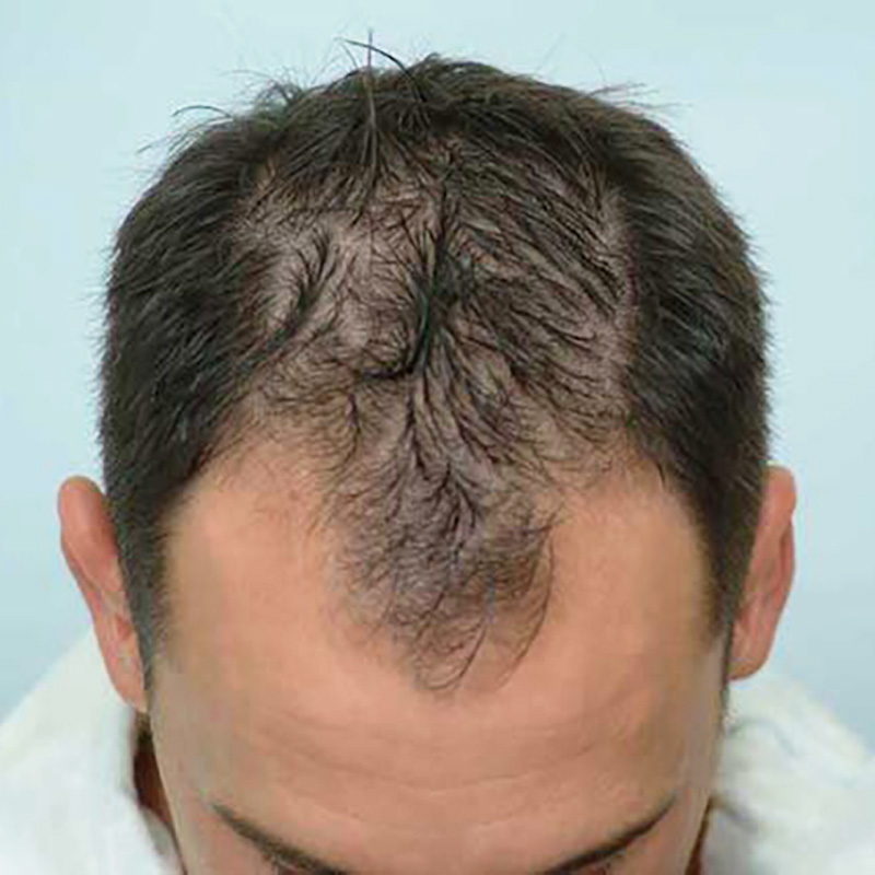 Hair Transplant 2910 grafts FUE