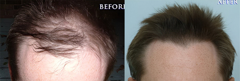 Hair Transplant 1040 grafts FUE front