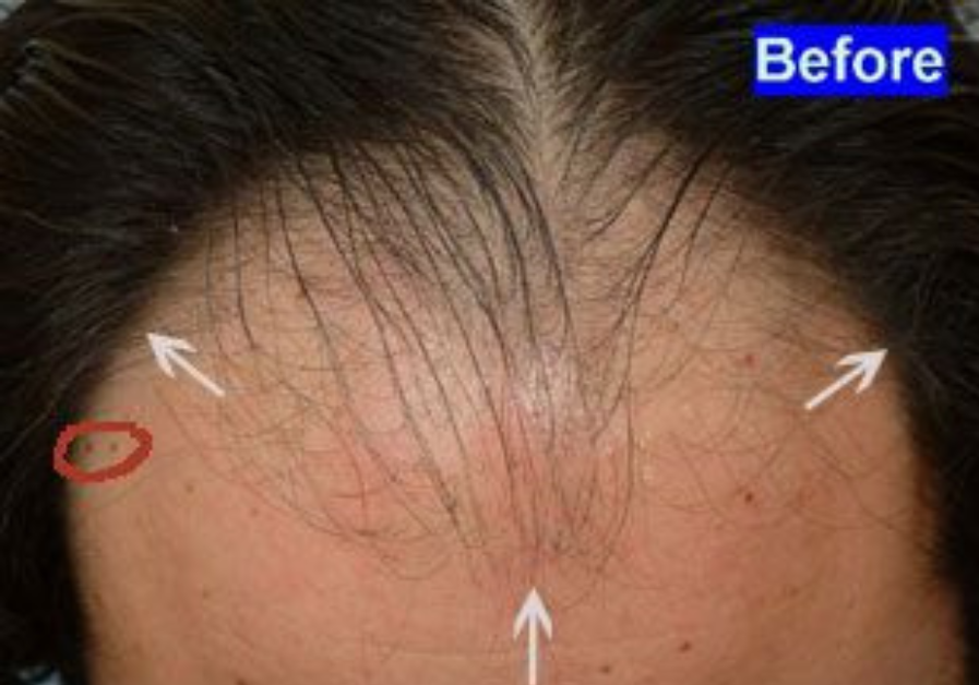 Hair Transplant 2650 grafts FUE