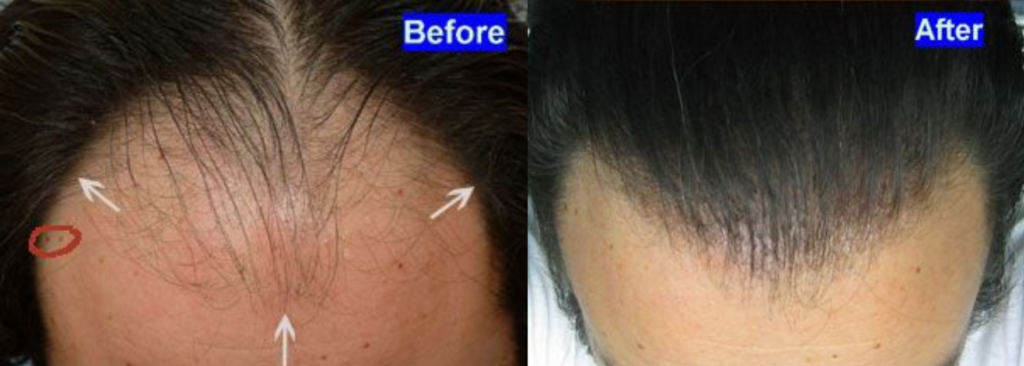 Hair Transplant 2650 grafts FUE