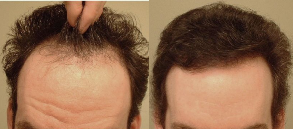 Hair Transplant 1300 grafts FUE