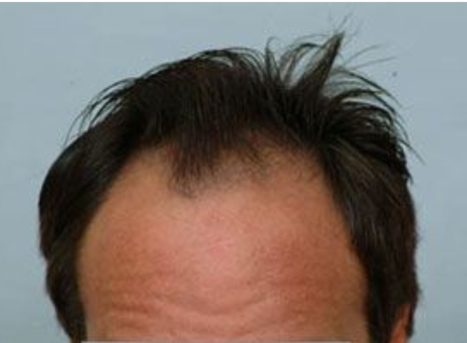 Hair Transplant 2499 grafts FUE