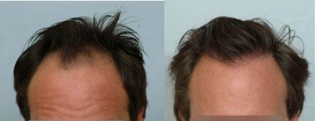 Hair Transplant 2499 grafts FUE