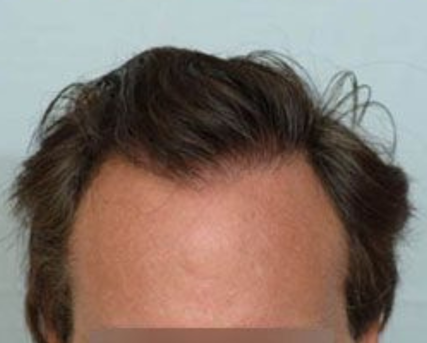 Hair Transplant 2499 grafts FUE