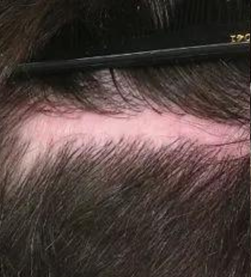 Scar Repair 300 grafts FUE