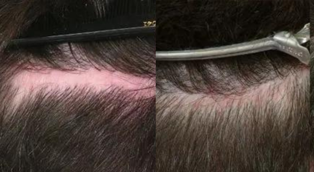 Scar Repair 300 grafts FUE