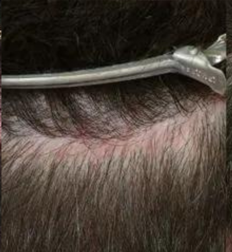 Scar Repair 300 grafts FUE