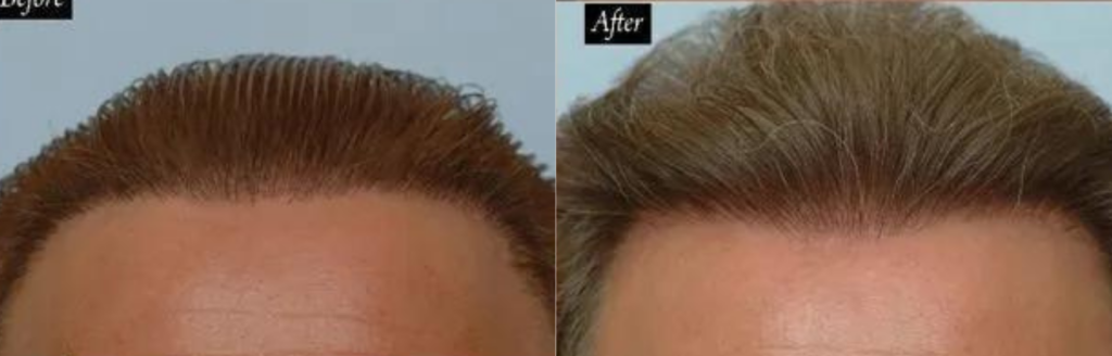  Hair Plug Redistribution 541 grafts