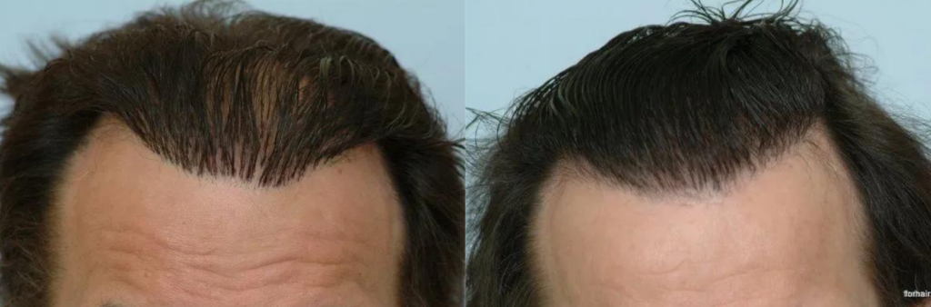 Hair Plug Redistribution