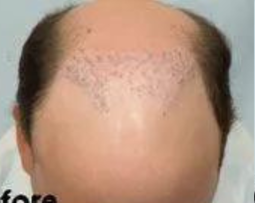Hair Plug Removal
