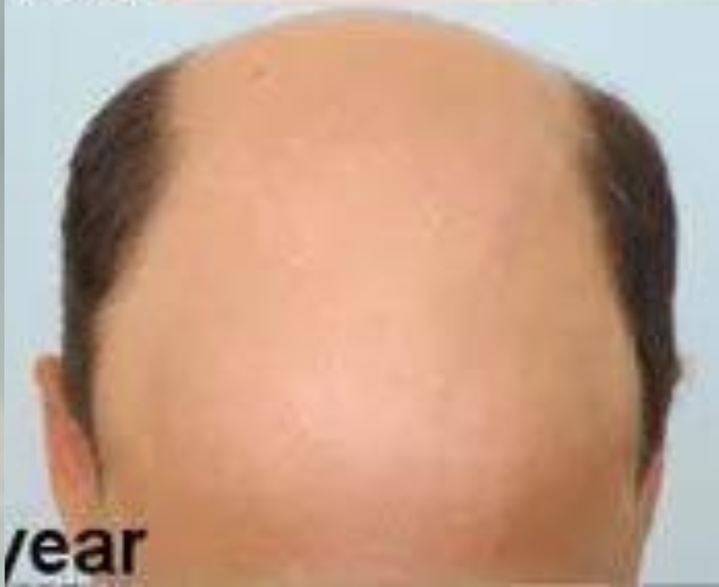 Hair Plug Removal