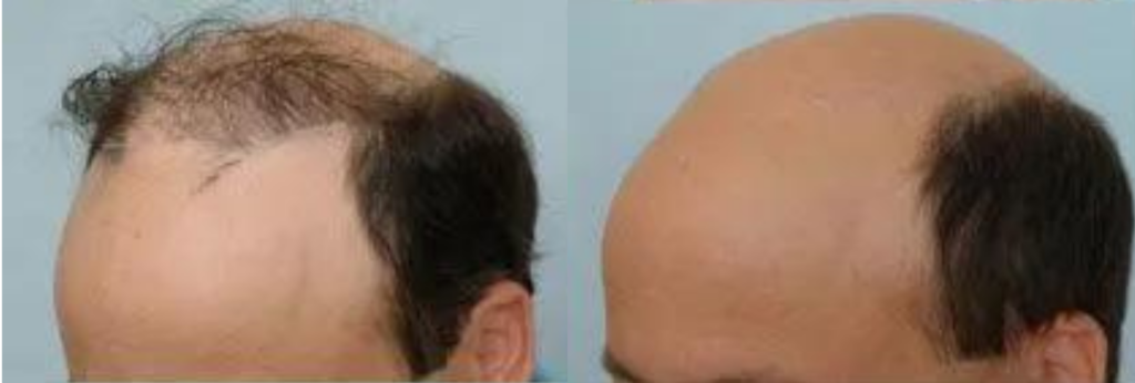  Hair Plug Removal