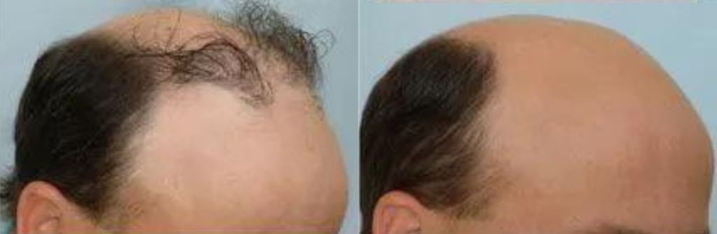  Hair Plug Removal