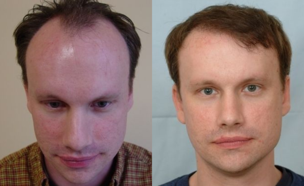 Hair Transplant 2001 grafts FUE