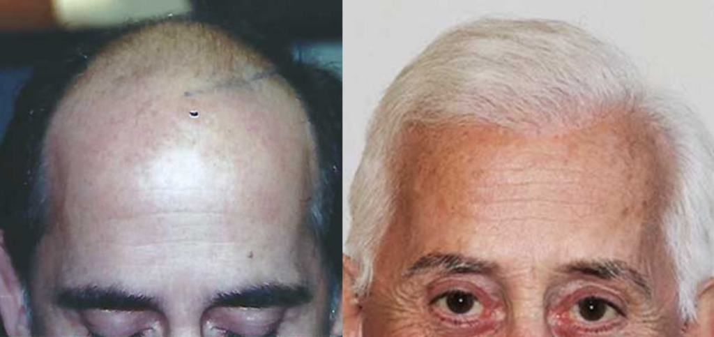 Hair transplant 7000 grafts FUE hairline