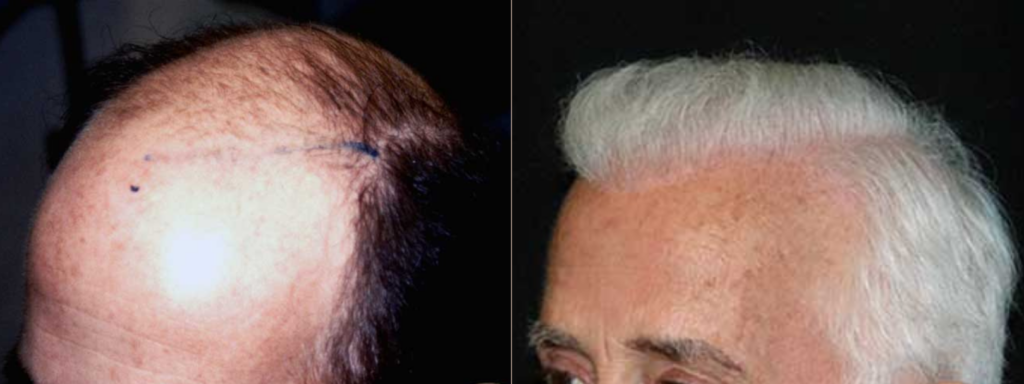 Hair transplant 7000 grafts FUE left