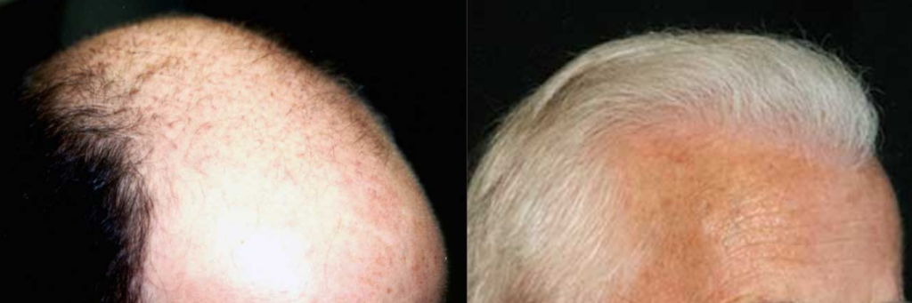 Hair transplant 7000 grafts FUE right