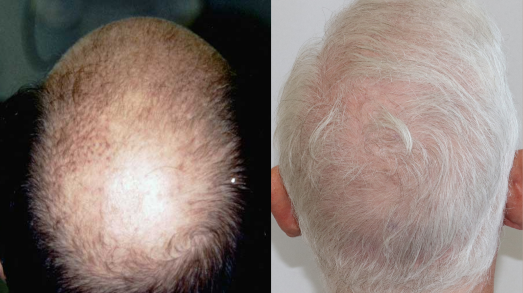 Hair transplant 7000 grafts FUE crown