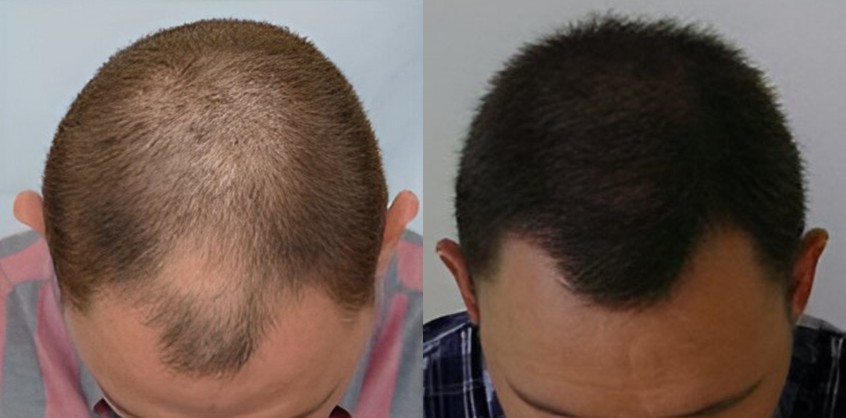 Hair Transplant 2300 grafts FUE