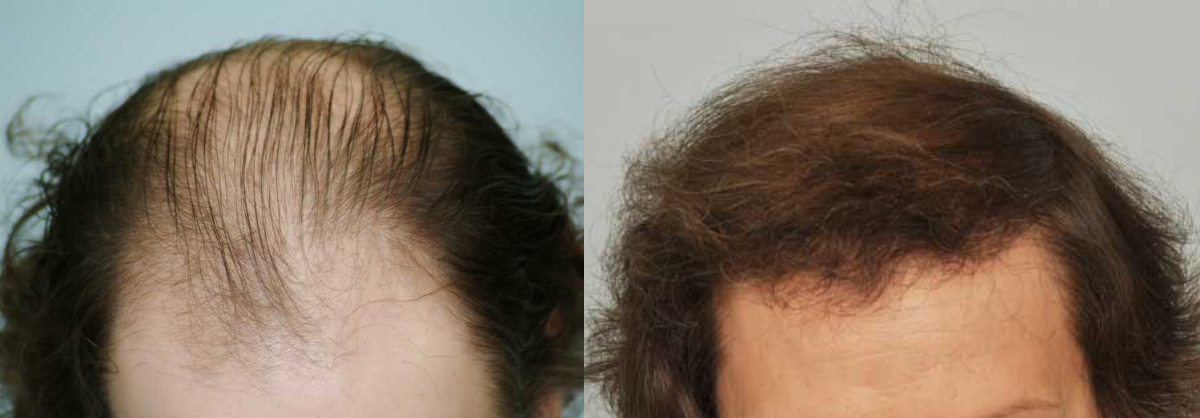 Hair Transplant 3200 grafts FUE