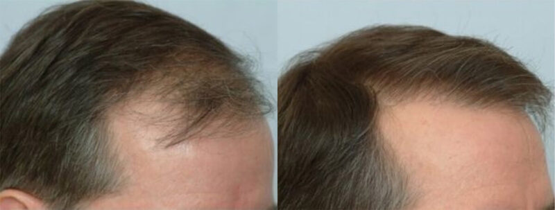 Hair Transplant 1400 grafts FUE - right