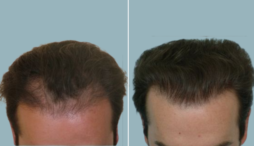 Hair Transplant 1680 grafts FUT