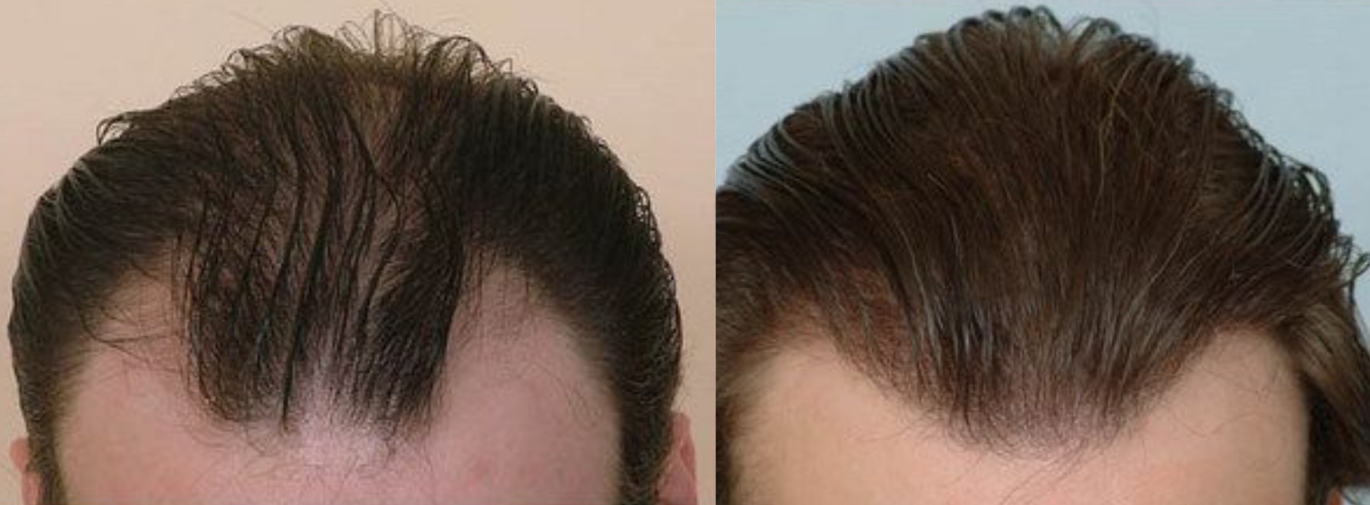 Hair Transplant 4800 grafts FUE