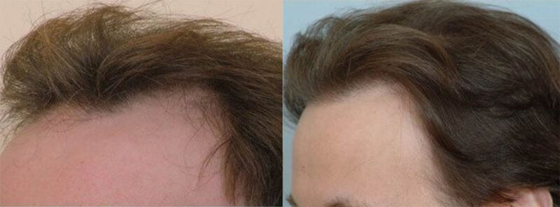 Hair Transplant 4800 grafts FUE left