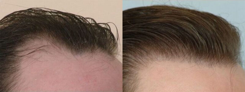 Hair Transplant 4800 grafts FUE right