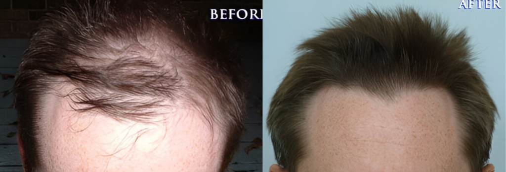 Hair Transplant 1040 grafts FUE
