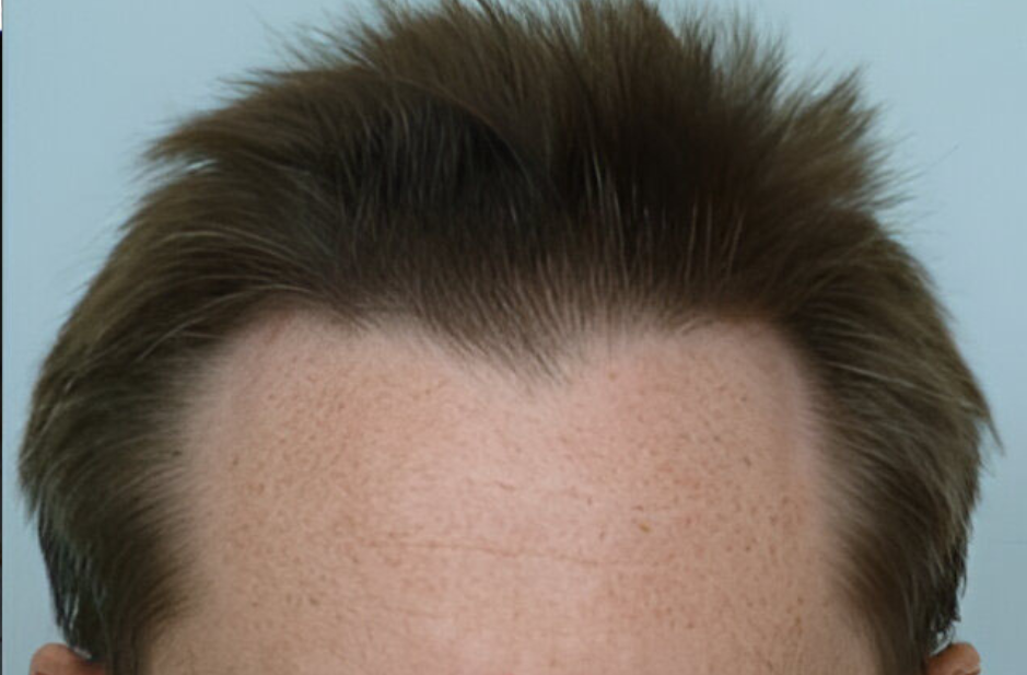 Hair Transplant 1040 grafts FUE